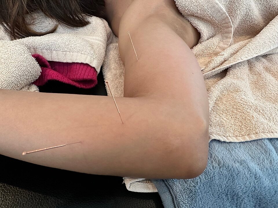 Dry Needling